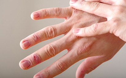 アトピー性皮膚炎に対する先進医療